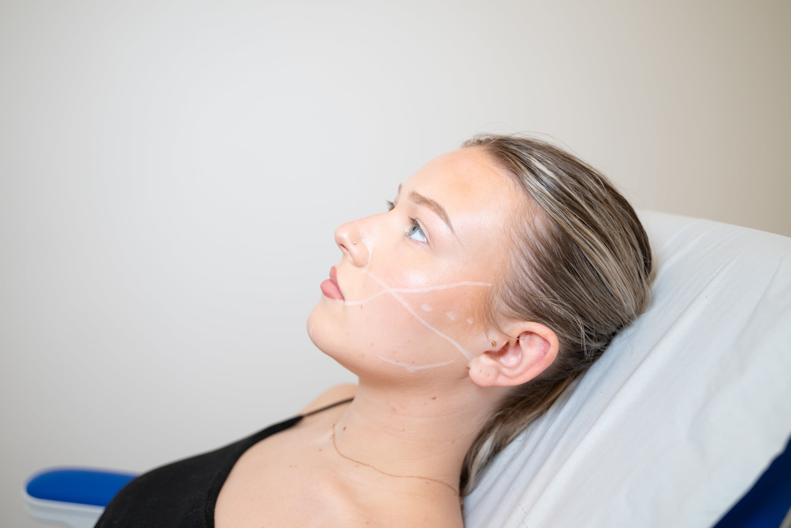 Acide hyaluronique : comprendre les sillons du visage